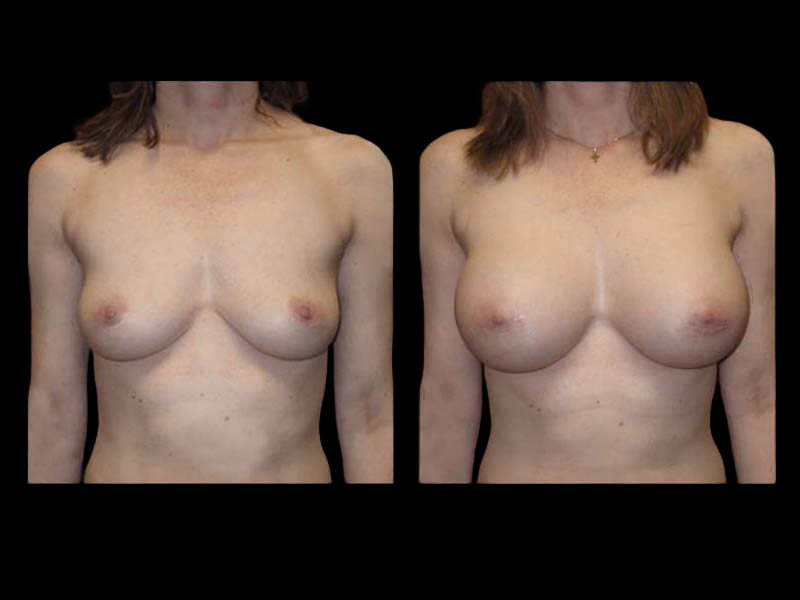 Breast Augmentation Before After Photos Case #13475 - Pancholi Cosmetic Surgery