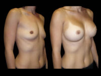 Breast Augmentation Before After Photos Case #13478 - Pancholi Cosmetic Surgery