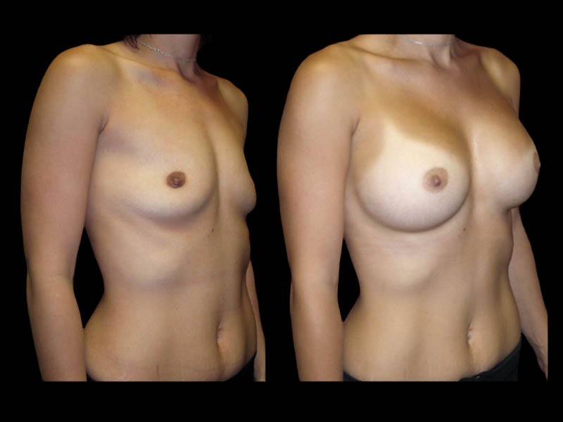 Breast Augmentation Before After Photos Case #13478 - Pancholi Cosmetic Surgery