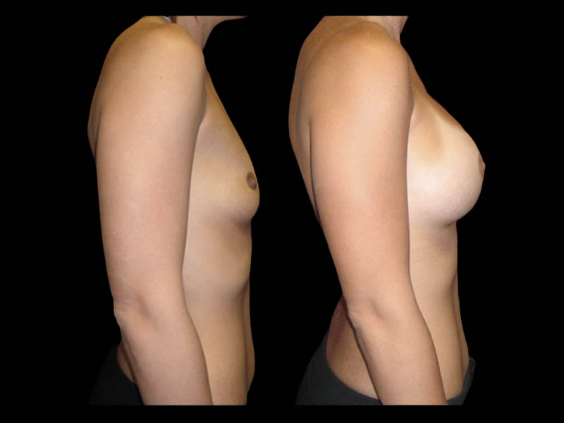 Breast Augmentation Before After Photos Case #13479 - Pancholi Cosmetic Surgery