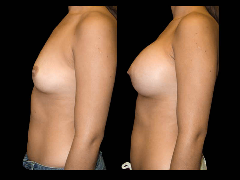 Breast Augmentation Before After Photos Case #13482 - Pancholi Cosmetic Surgery