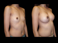 Breast Augmentation Before After Photos Case #13484 - Pancholi Cosmetic Surgery