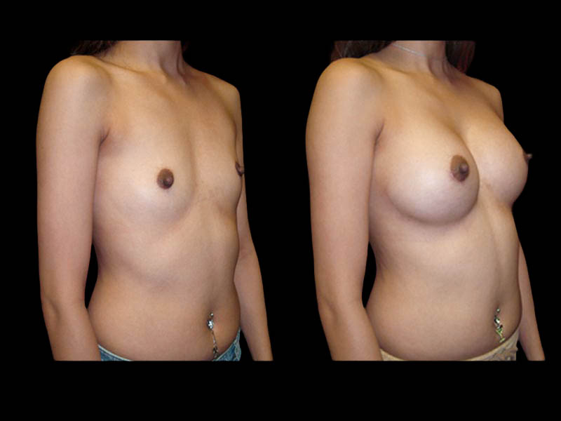 Breast Augmentation Before After Photos Case #13484 - Pancholi Cosmetic Surgery