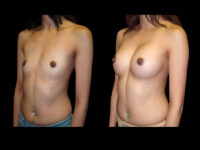 Breast Augmentation Before After Photos Case #13485 - Pancholi Cosmetic Surgery