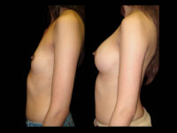 Breast Augmentation Before After Photos Case #13486 - Pancholi Cosmetic Surgery