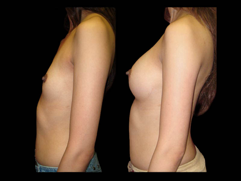 Breast Augmentation Before After Photos Case #13486 - Pancholi Cosmetic Surgery