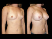Breast Augmentation Before After Photos Case #13488 - Pancholi Cosmetic Surgery