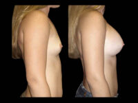 Breast Augmentation Before After Photos Case #13489 - Pancholi Cosmetic Surgery