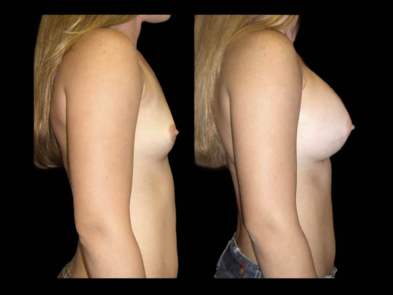Breast Augmentation Before After Photos Case #13489 - Pancholi Cosmetic Surgery