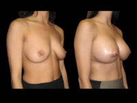 Breast Augmentation Before After Photos Case #13491 - Pancholi Cosmetic Surgery