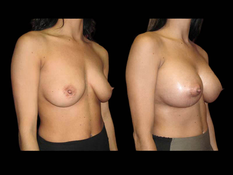 Breast Augmentation Before After Photos Case #13491 - Pancholi Cosmetic Surgery