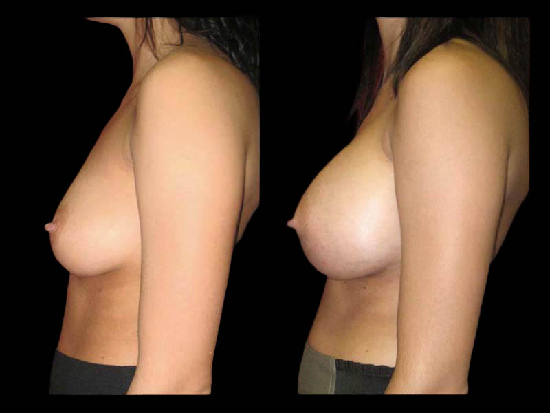 Breast Augmentation Before After Photos Case #13492 - Pancholi Cosmetic Surgery