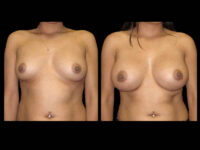 Breast Augmentation Before After Photos Case #13494 - Pancholi Cosmetic Surgery