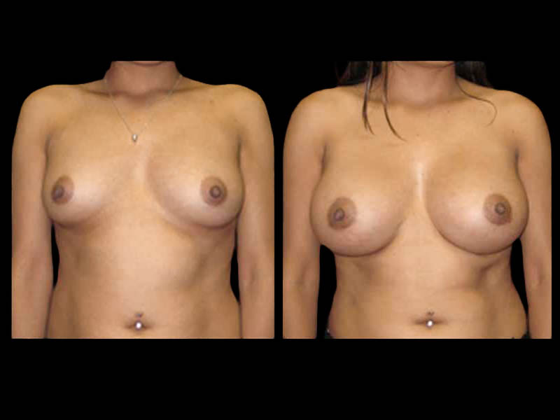 Breast Augmentation Before After Photos Case #13494 - Pancholi Cosmetic Surgery