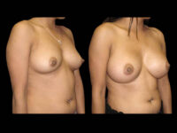 Breast Augmentation Before After Photos Case #13495 - Pancholi Cosmetic Surgery
