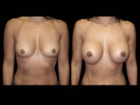 Breast Before After Photos Breast Augmentation Before After Photos Case #13414 - Pancholi Cosmetic Surgery
