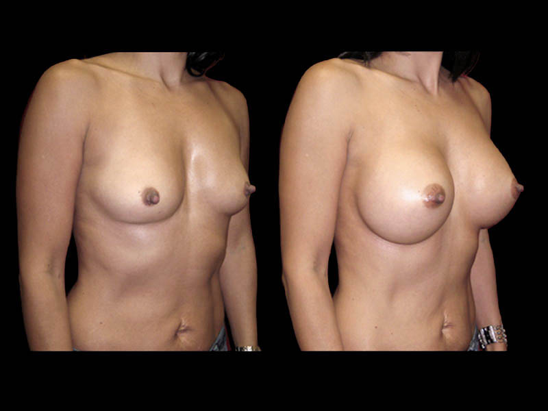 Breast Before After Photos Breast Augmentation Before After Photos Case #13415 - Pancholi Cosmetic Surgery