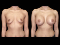 Breast Before After Photos Breast Augmentation Before After Photos Case #13417 - Pancholi Cosmetic Surgery