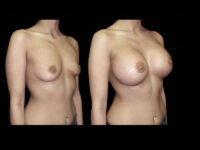 Breast Before After Photos Breast Augmentation Before After Photos Case #13418 - Pancholi Cosmetic Surgery