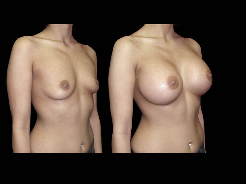 Breast Before After Photos Breast Augmentation Before After Photos Case #13418 - Pancholi Cosmetic Surgery