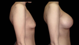 Breast Before After Photos Breast Augmentation Before After Photos Case #13419 - Pancholi Cosmetic Surgery