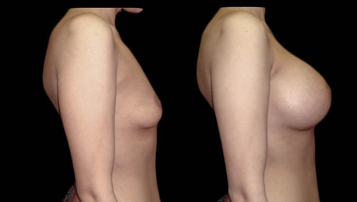 Breast Before After Photos Breast Augmentation Before After Photos Case #13419 - Pancholi Cosmetic Surgery
