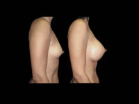 Breast Before After Photos Breast Augmentation Before After Photos Case #13420 - Pancholi Cosmetic Surgery