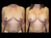 Breast Before After Photos Breast Augmentation Before After Photos Case #13422 - Pancholi Cosmetic Surgery