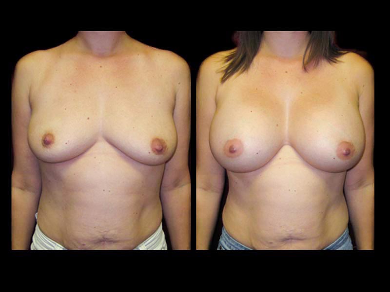 Breast Before After Photos Breast Augmentation Before After Photos Case #13422 - Pancholi Cosmetic Surgery