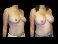 Breast Before After Photos Breast Augmentation Before After Photos Case #13423 - Pancholi Cosmetic Surgery