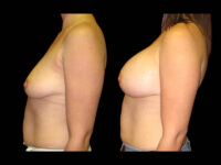 Breast Before After Photos Breast Augmentation Before After Photos Case #13424 - Pancholi Cosmetic Surgery