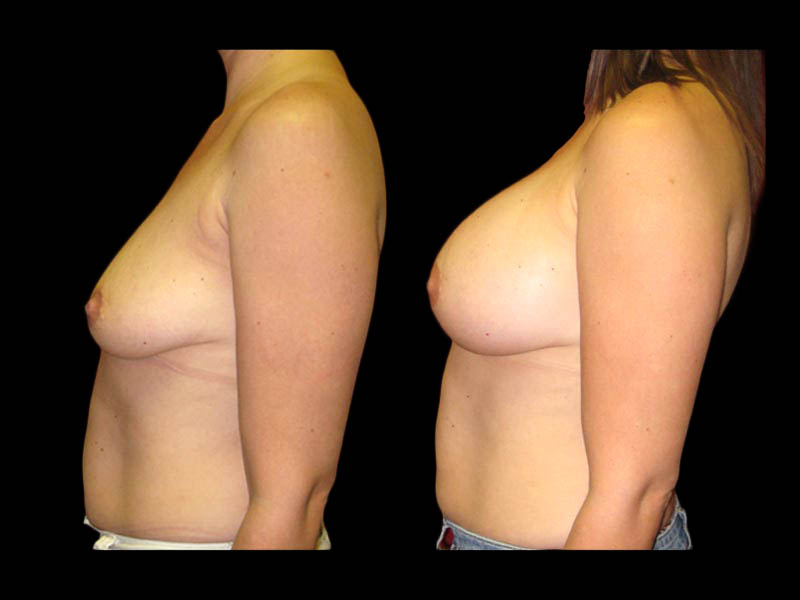 Breast Before After Photos Breast Augmentation Before After Photos Case #13424 - Pancholi Cosmetic Surgery