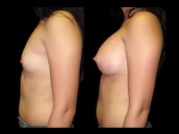 Breast Before After Photos Breast Augmentation Before After Photos Case #13428 - Pancholi Cosmetic Surgery