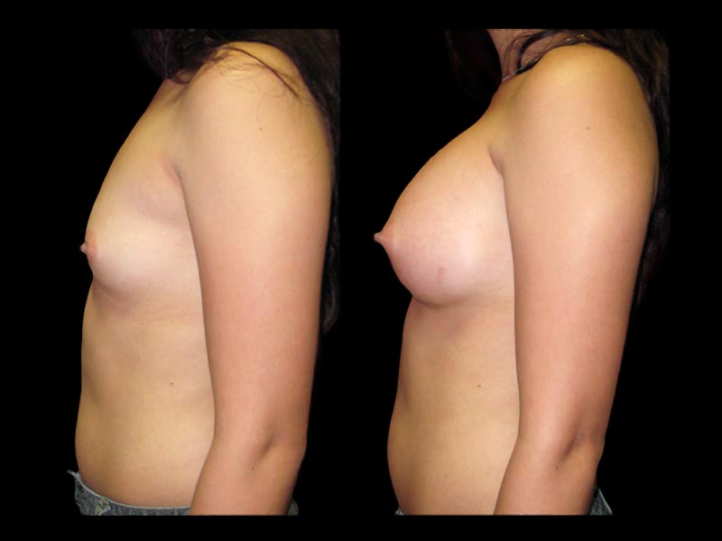 Breast Before After Photos Breast Augmentation Before After Photos Case #13428 - Pancholi Cosmetic Surgery