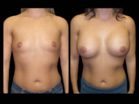 Breast Before After Photos Breast Augmentation Before After Photos Case #13430 - Pancholi Cosmetic Surgery