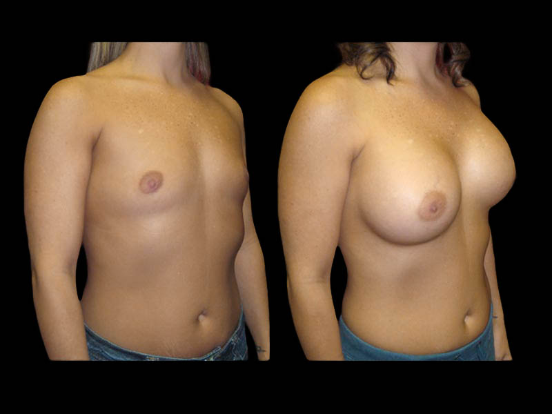 Breast Before After Photos Breast Augmentation Before After Photos Case #13431 - Pancholi Cosmetic Surgery