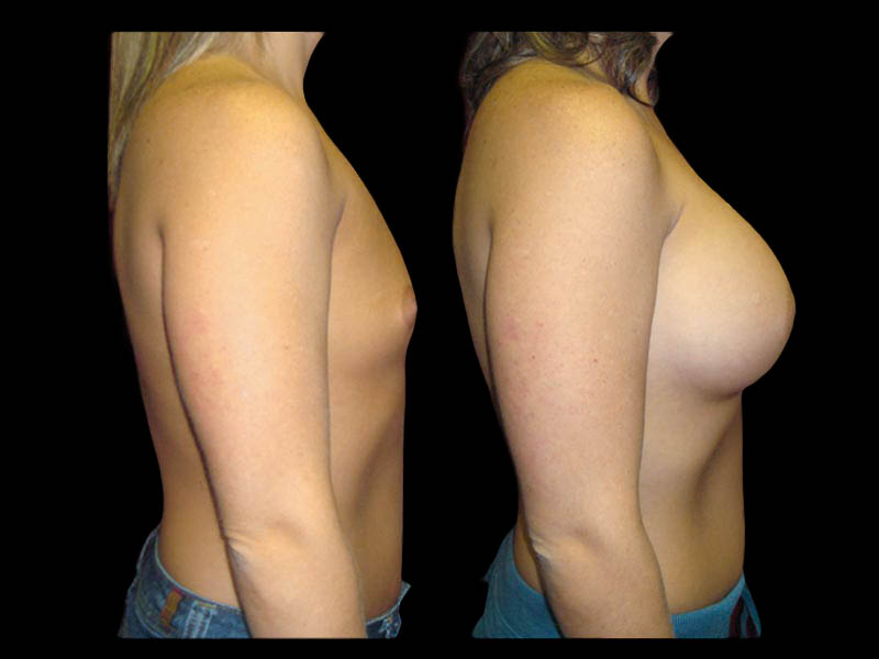 Breast Before After Photos Breast Augmentation Before After Photos Case #13432 - Pancholi Cosmetic Surgery