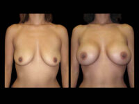 Breast Before After Photos Breast Augmentation Before After Photos Case #13434 - Pancholi Cosmetic Surgery