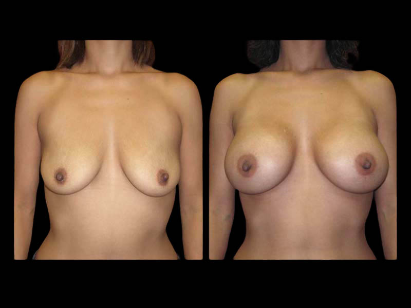 Breast Before After Photos Breast Augmentation Before After Photos Case #13434 - Pancholi Cosmetic Surgery