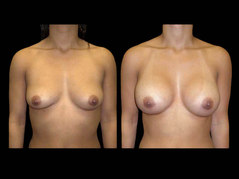 Breast Before After Photos Breast Augmentation Before After Photos Case #13437 - Pancholi Cosmetic Surgery