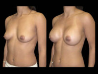 Breast Before After Photos Breast Augmentation Before After Photos Case #13438 - Pancholi Cosmetic Surgery