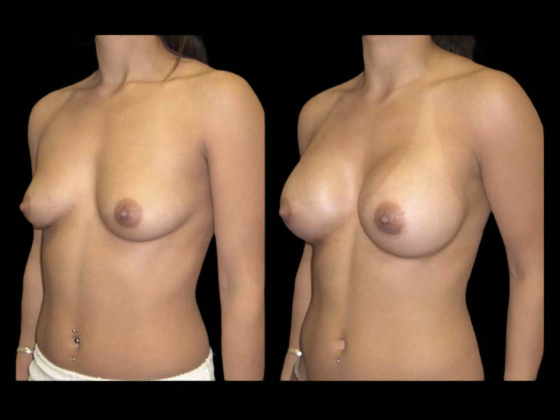 Breast Before After Photos Breast Augmentation Before After Photos Case #13438 - Pancholi Cosmetic Surgery