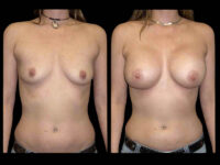 Breast Before After Photos Breast Augmentation Before After Photos Case #13441 - Pancholi Cosmetic Surgery