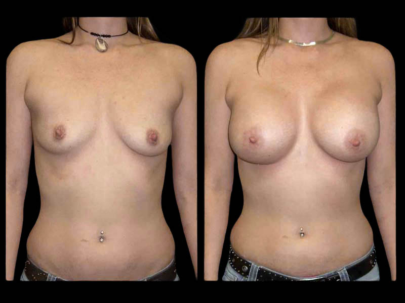 Breast Before After Photos Breast Augmentation Before After Photos Case #13441 - Pancholi Cosmetic Surgery