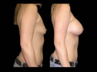 Breast Before After Photos Breast Augmentation Before After Photos Case #13442 - Pancholi Cosmetic Surgery