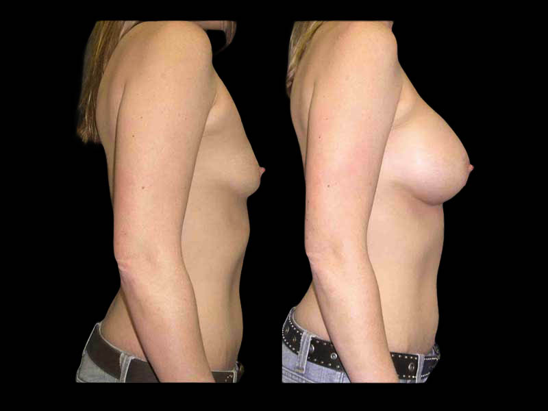 Breast Before After Photos Breast Augmentation Before After Photos Case #13442 - Pancholi Cosmetic Surgery