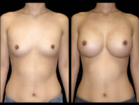 Breast Before After Photos Breast Augmentation Before After Photos Case #13444 - Pancholi Cosmetic Surgery