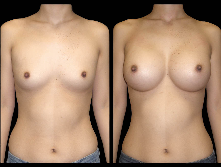 Breast Before After Photos Breast Augmentation Before After Photos Case #13444 - Pancholi Cosmetic Surgery