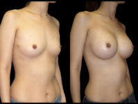 Breast Before After Photos Breast Augmentation Before After Photos Case #13445 - Pancholi Cosmetic Surgery