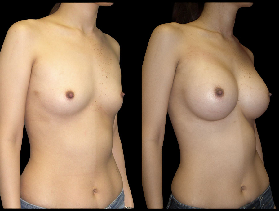 Breast Before After Photos Breast Augmentation Before After Photos Case #13445 - Pancholi Cosmetic Surgery